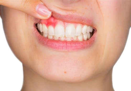 Do you need to worry about gum disease with dentures?